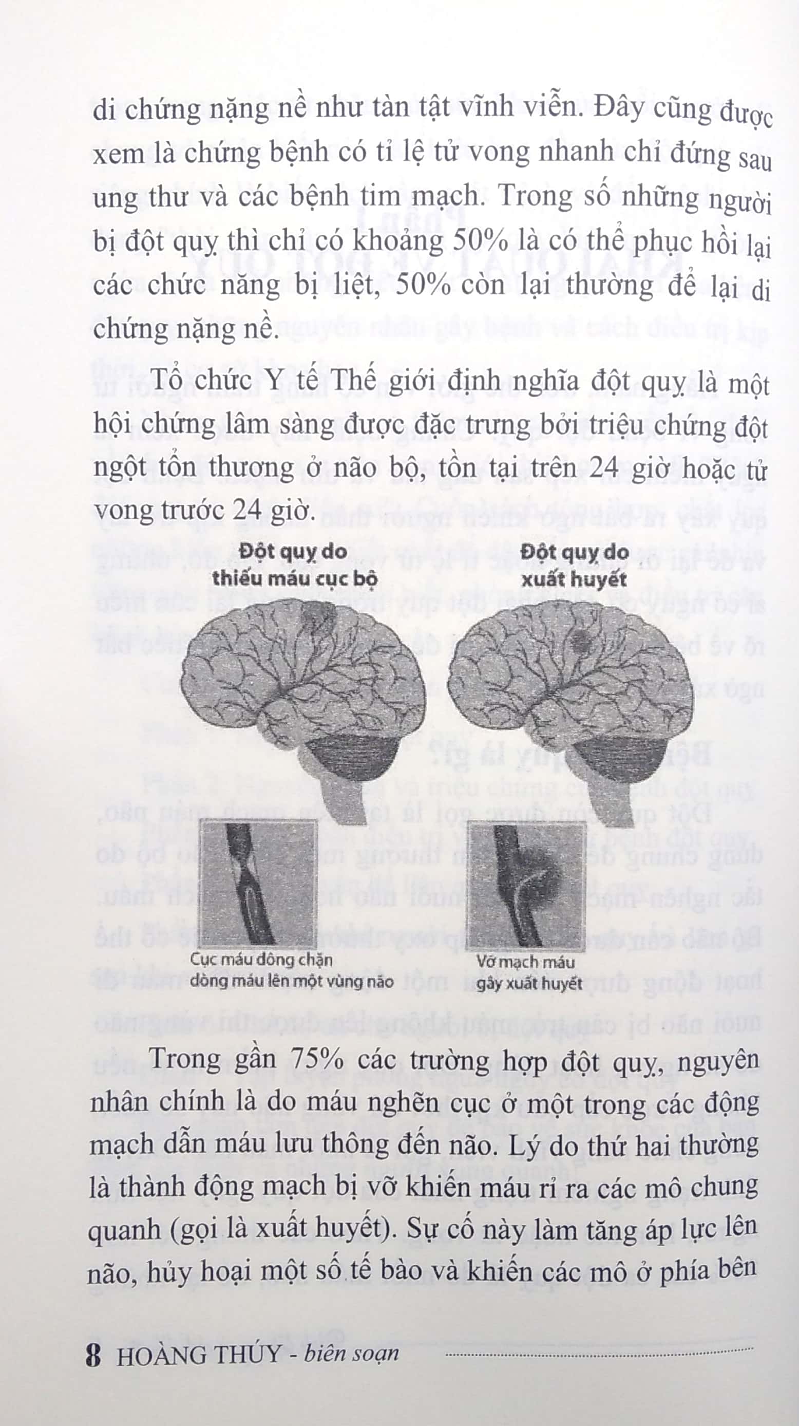 bệnh đột quỵ và cách điều trị - Ảnh 6